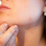Wat kun je doen tegen hormonale acne?
