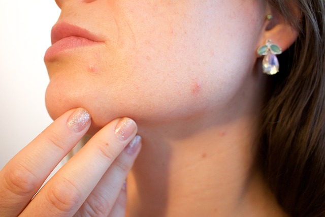 Wat kun je doen tegen hormonale acne?